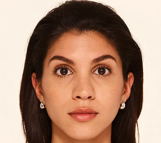 Botox Before & After