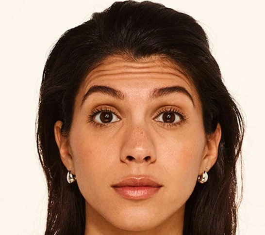 Botox Before & After