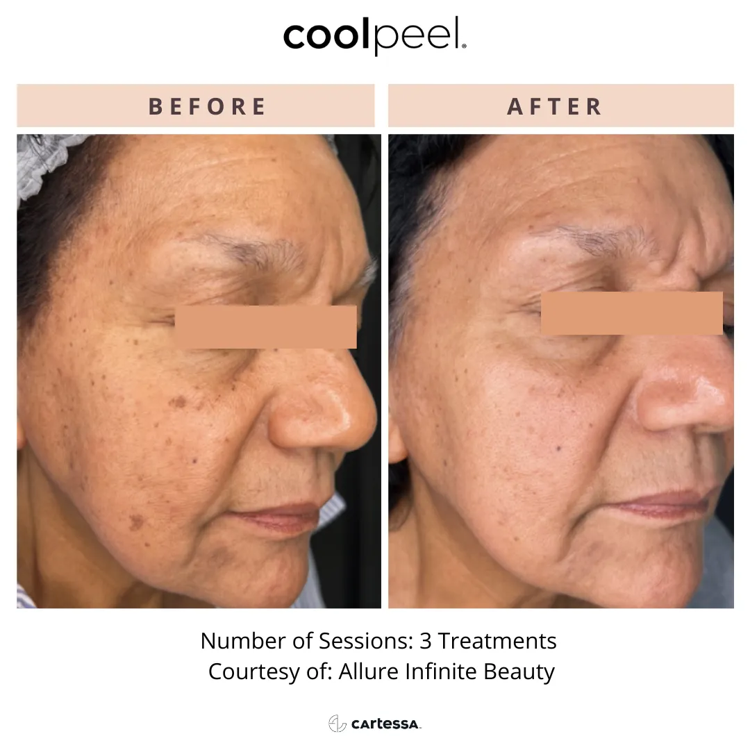 HELIX CO2 Laser Resurfacing Before & After