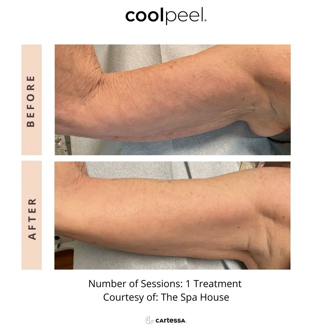 HELIX CO2 Laser Resurfacing Before & After