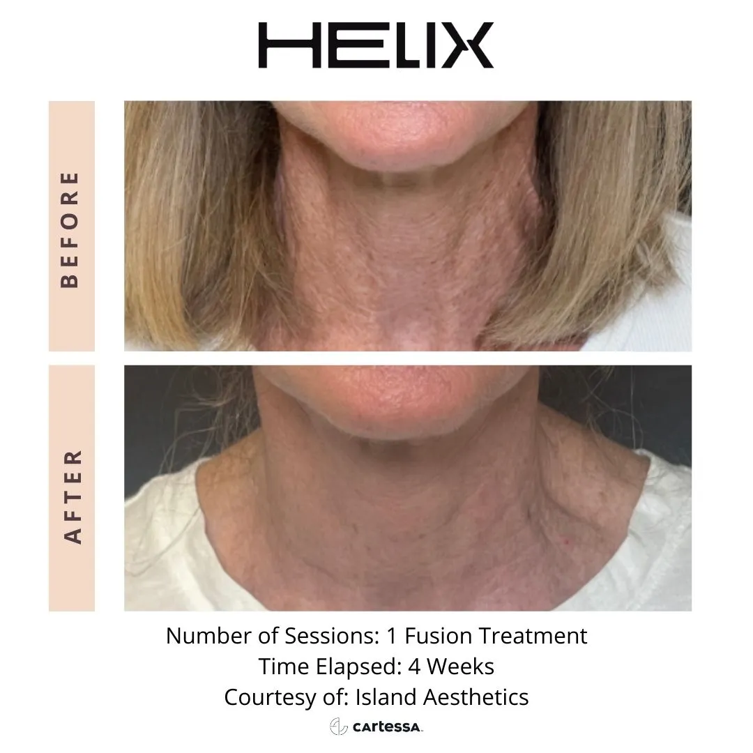 HELIX CO2 Laser Resurfacing Before & After