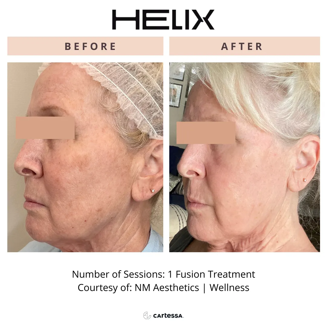 HELIX CO2 Laser Resurfacing Before & After
