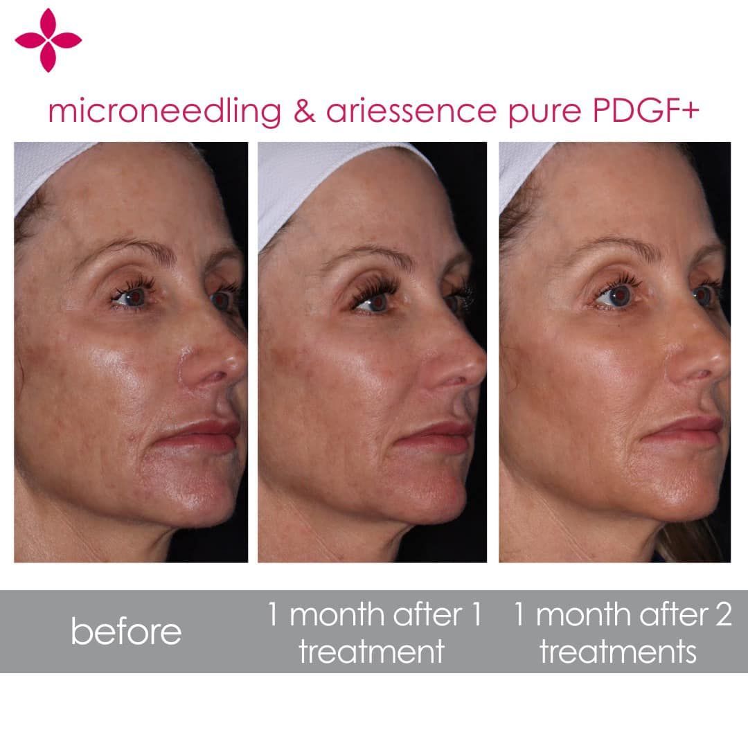 Microneedling treatment results before and after.