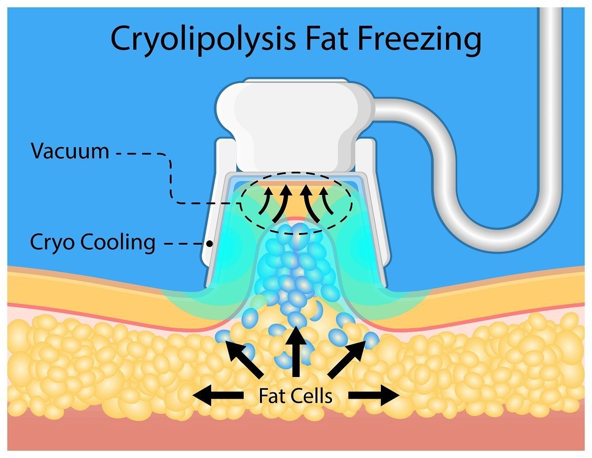 Diagram explaining cryolipolysis fat freezing process.