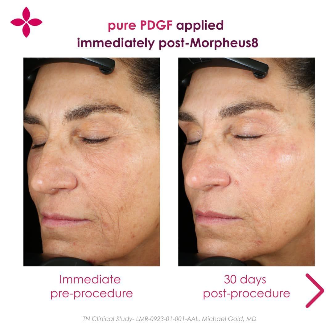 Before and after skin treatment with PDGF.